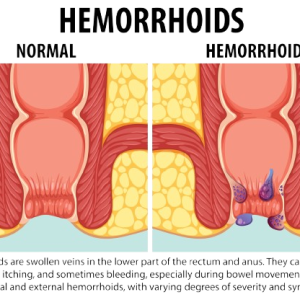 Piles Natural Hemorrhoid Treatment - Product Image