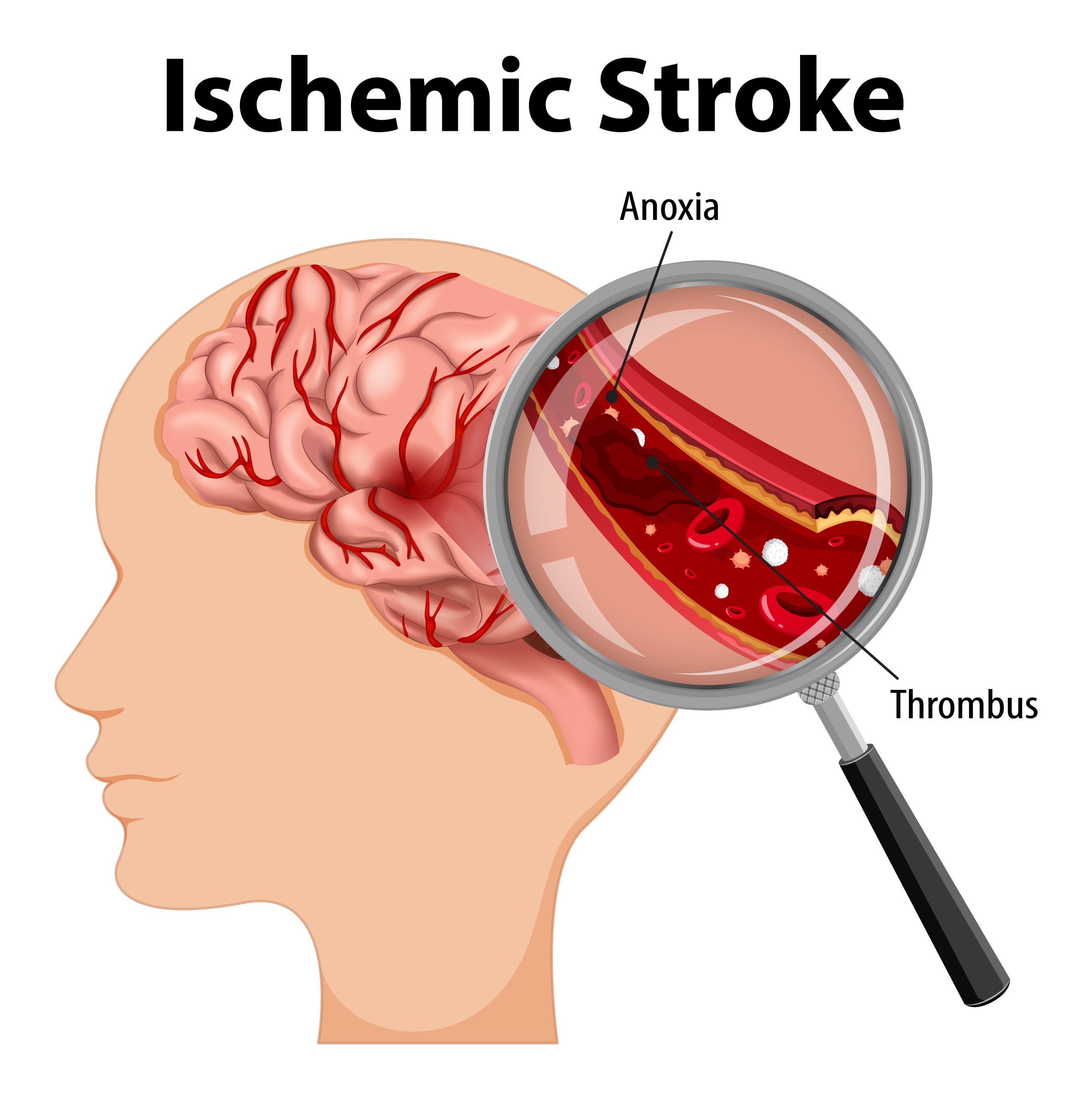 Brain Stroke Prevention care product image