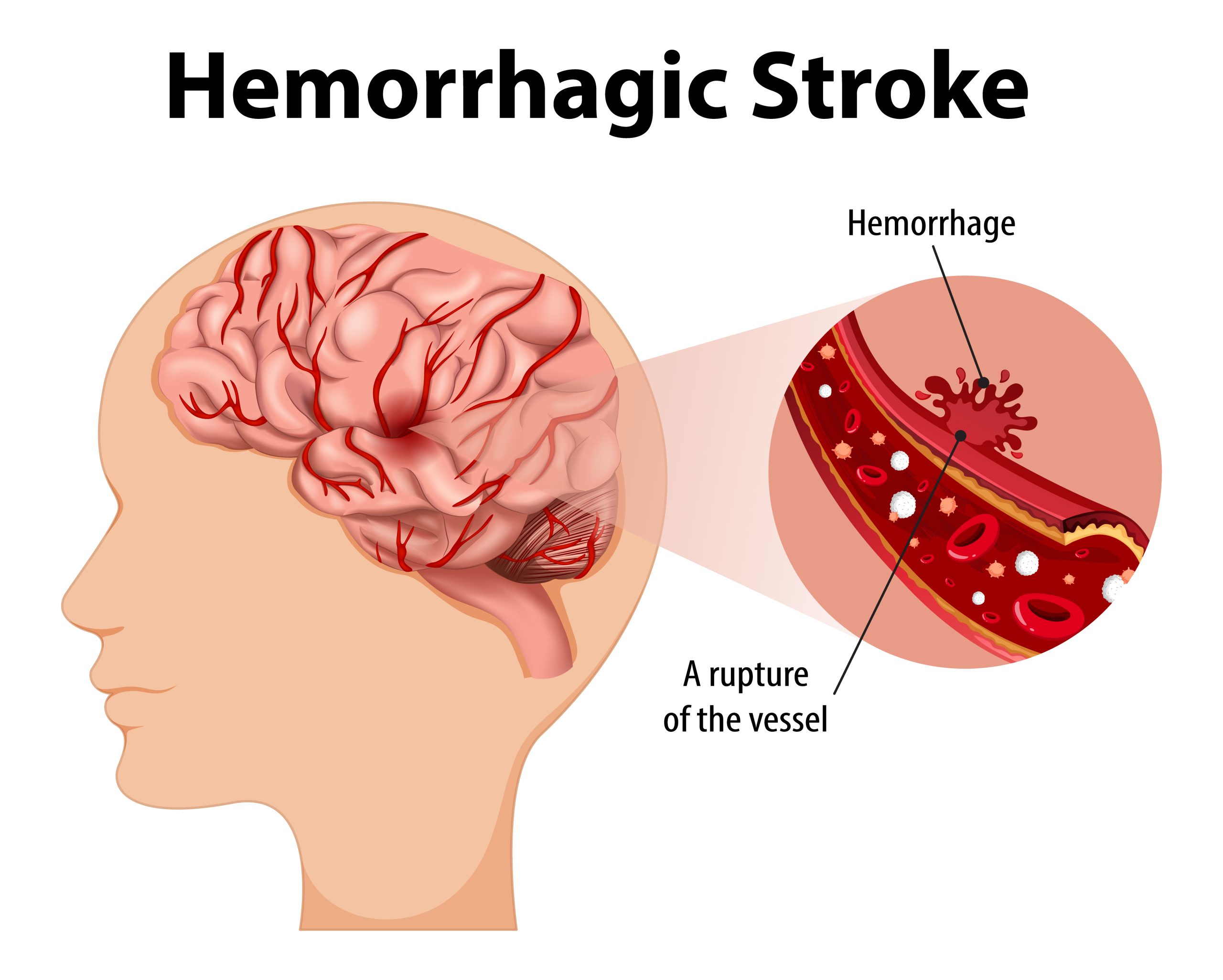 Herrhagic stroke image for Stroke Prevention Brain care package