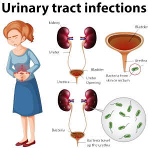 Urinary Tract Infection Product image